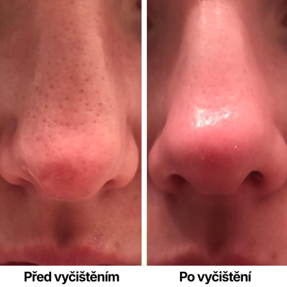 Skinsense™ Vakuový čistič pórů